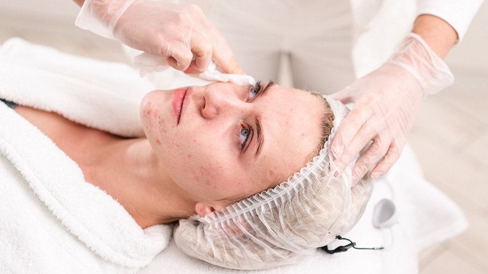 What are the best skin treatments for acne 960x540 1